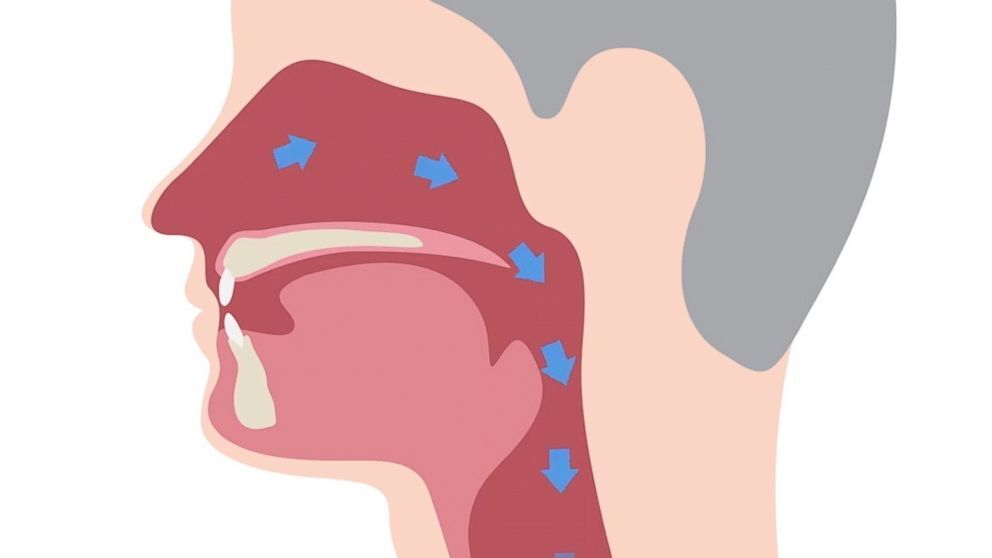 Anatomiska ilustrācija, kas parāda cilvēka rīkli ar virziena bultiņām. Rīgas 1. slimnīca.