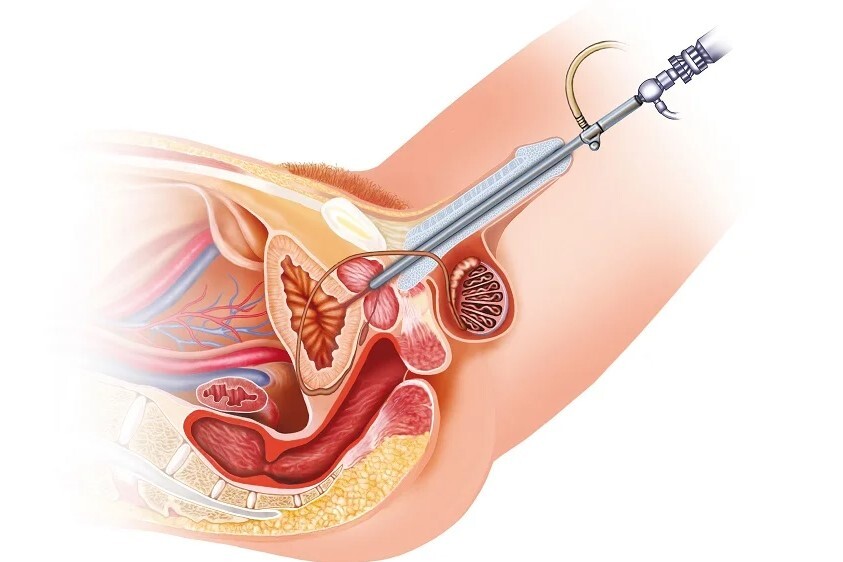 Attēls parāda ķirurģisku instrumentu, kas tiek izmantots iekšējās anatomijas izpētē. Rīgas 1. slimnīca.