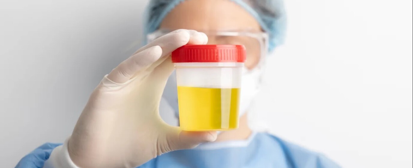 Medicīnas darbinieks tur urīna paraugu caurspīdīgā traukā ar sarkanu vāciņu. Fons ir gaišs un neitrāls.
