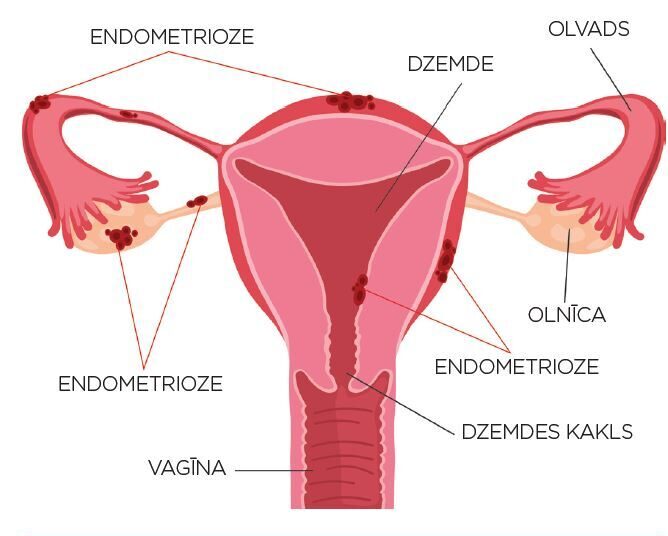 Zīmējums parāda sieviešu reproduktīvo sistēmu ar atzīmētām endometriozes vietām. Atslēgvārdi: dzemde, olnīca, vagīna.