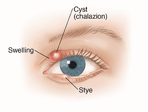 Acī redzama pietūkums ar apzīmējumiem: cista (chalazion) un miežu grauds.