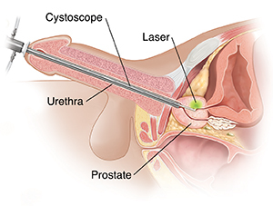 Cistoskopija ar lāzeri, attēlā redzama urīnizvadkanāla un prostatas anatomija.