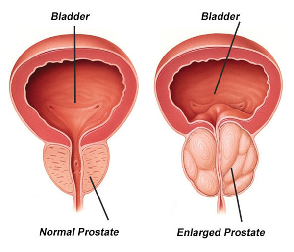 Attēls salīdzina normālu un palielinātu prostatu, norādot uz urīnpūsli un prostatas stāvokli.