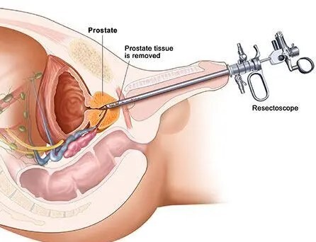 Attēls parāda prostatas operāciju ar rezekcijas endoskopu, no kura tiek noņemta prostatas audi.