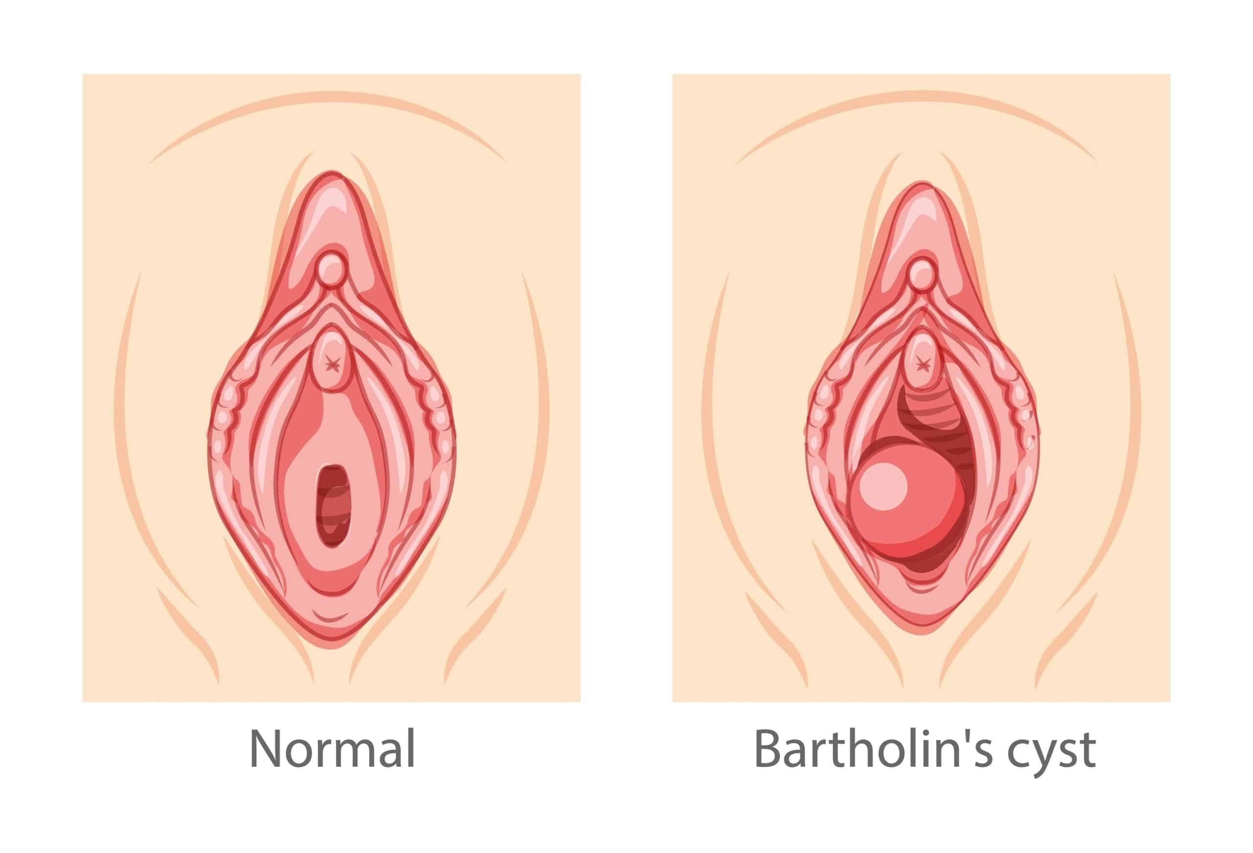 Attēls salīdzina normālu anatomiju un Bartholina cistu. Kreisajā pusē ir 