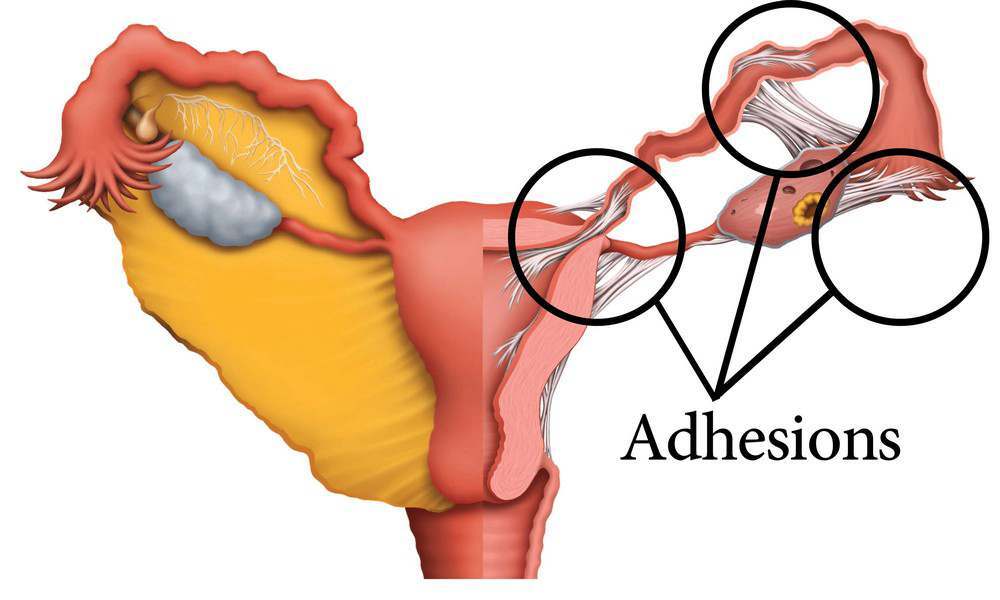Zīmējums parādā sieviešu reproduktīvās sistēmas anatomiju ar uzsvaru uz 