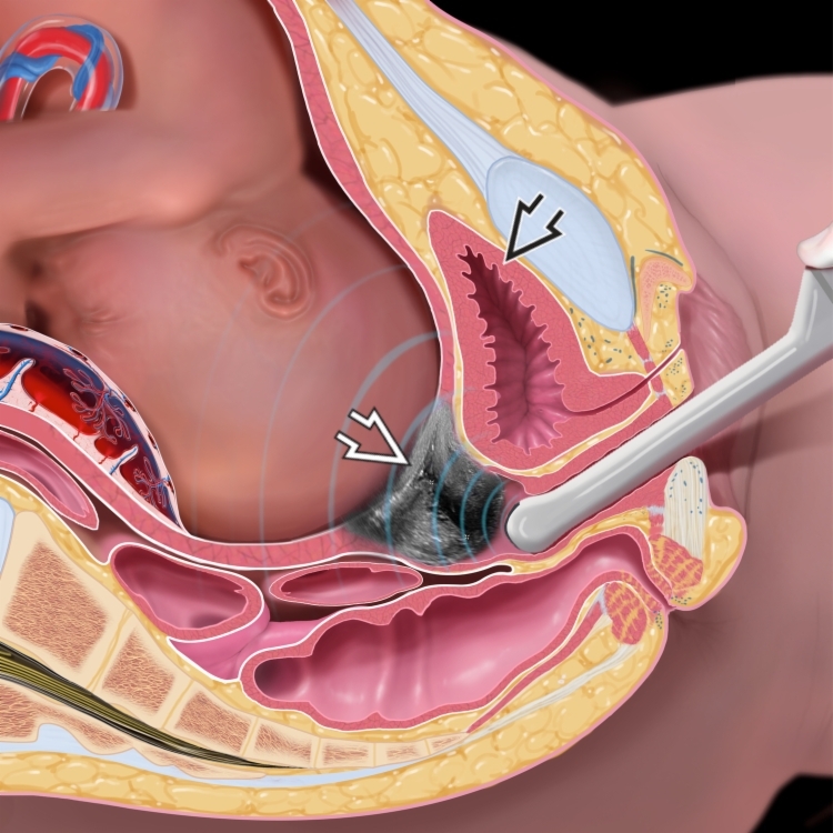 Anatomiska ilustrācija, kas parāda sievietes reproduktīvo sistēmu un ultraskaņas procedūru.