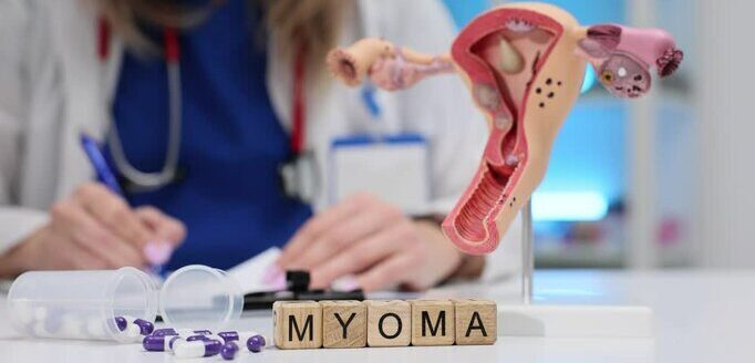 Attēls ar anatomisku modeli, kas parāda dzemdi un vārdu "MYOMA" koka kubiņos. Fons: ārsts pie darba.