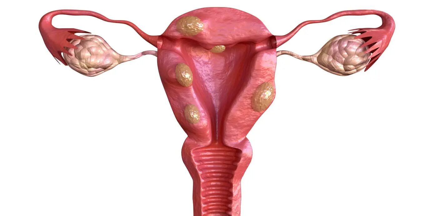 Anatomisks attēls, kas parāda dzemdi un olnīcas ar cistām. Rīgas 1. slimnīca.