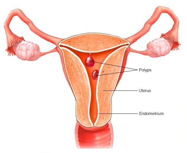 Zīmējums attēlo dzemdi ar polipiem, endometriju un dzemdes kaklu. Atzīmēti galvenie anatomiskie elementi.