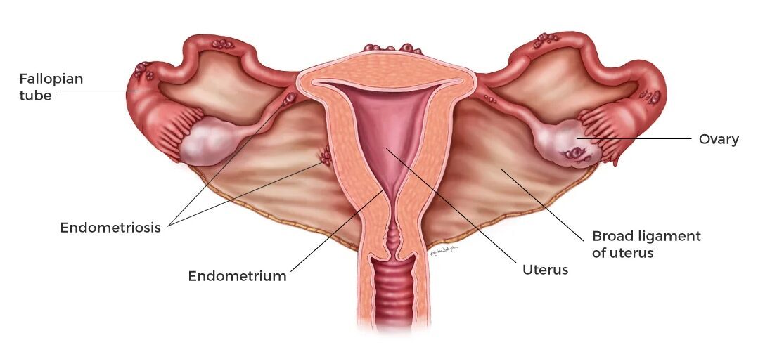 Zīmējums par sieviešu reproduktīvo sistēmu ar iezīmētām struktūrām: olvadi, olnīca, dzemde, endometrioze.