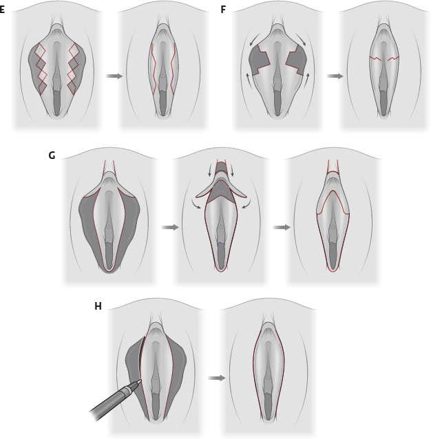 Attēls parāda ķirurģiskos procesus E, F, G un H, kas saistīti ar anatomiskām izmaiņām.