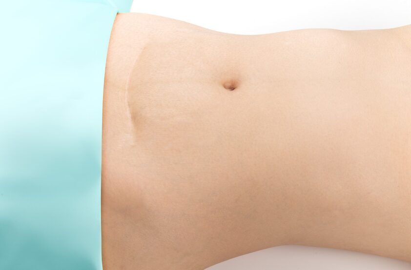 Attēls rāda cilvēka vēderu ar nabas daļu, fons ir gaiši zils. Rīgas 1. slimnīca.