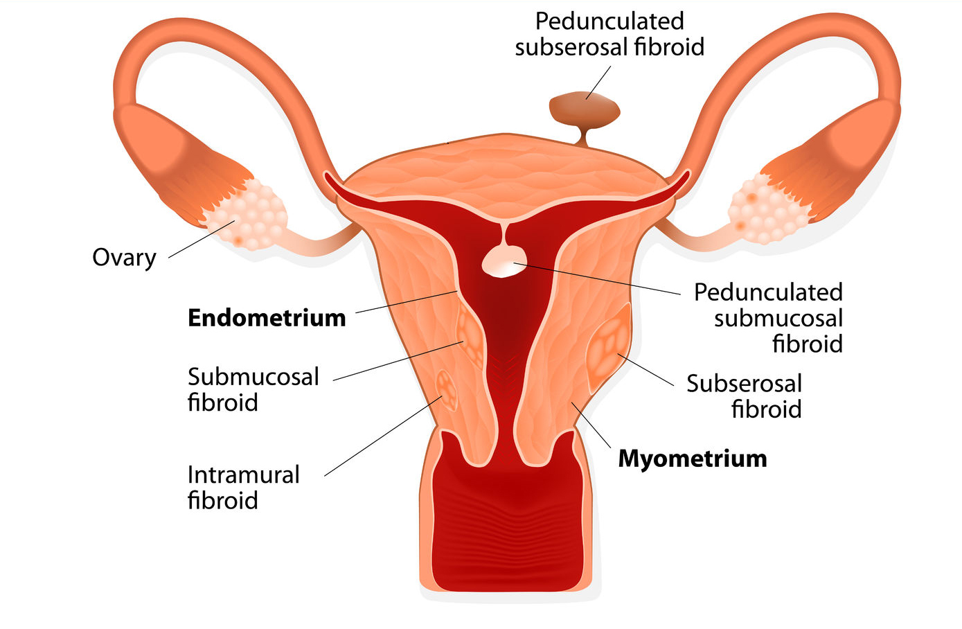 Uterusa anatomija ar atzīmētām struktūrām: endometrijs, myometrium, submucosal un subserosal fibroidi.