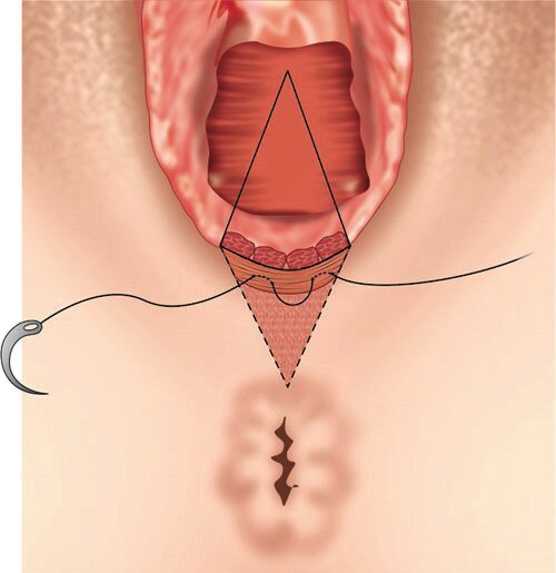 Zīmējums par rīkles anatomiju ar iezīmētu traheju un ķirurģisko instrumentu.