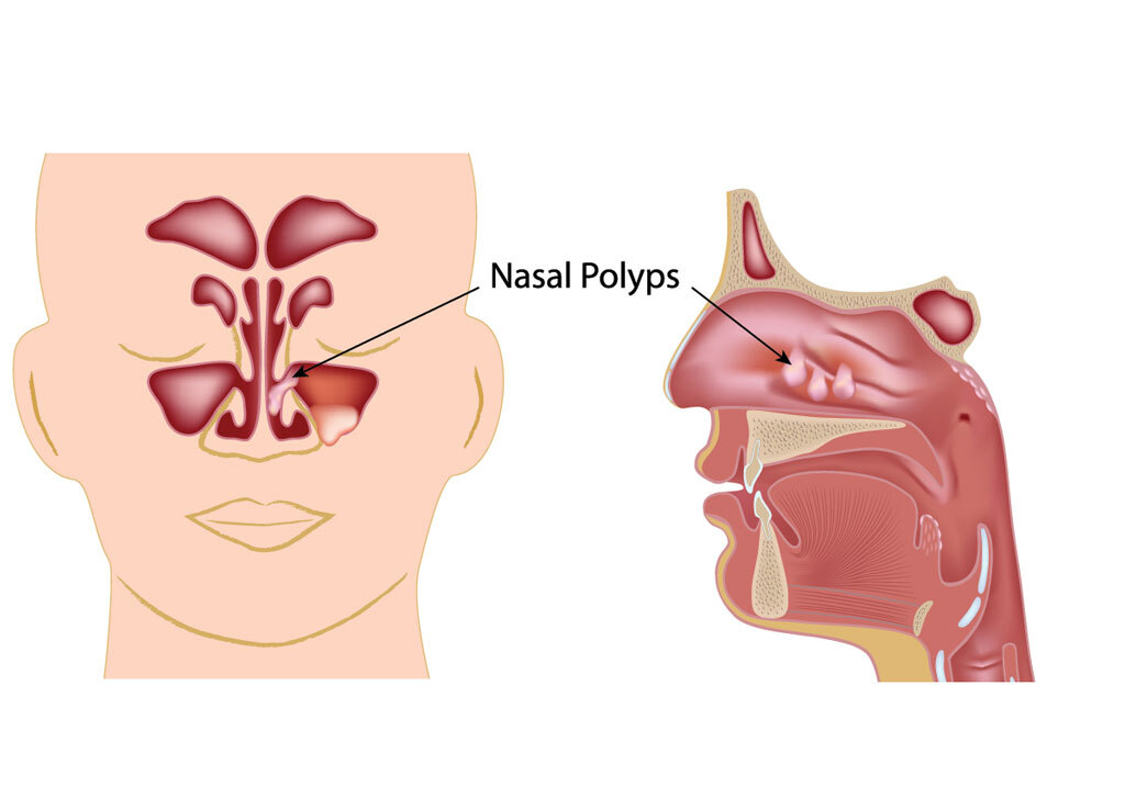 Attēls parāda deguna polipus, norādot to atrašanās vietu deguna un rīkles anatomijā.
