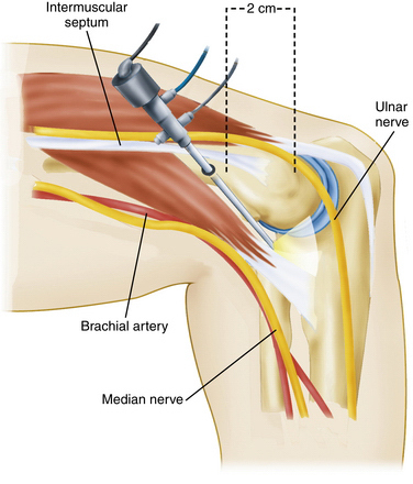 Zīmējums parāda elkoņa anatomiju ar intermuskuļu starpsienu, ulnāro nervu, brahiālo artēriju un vidējo nervu.