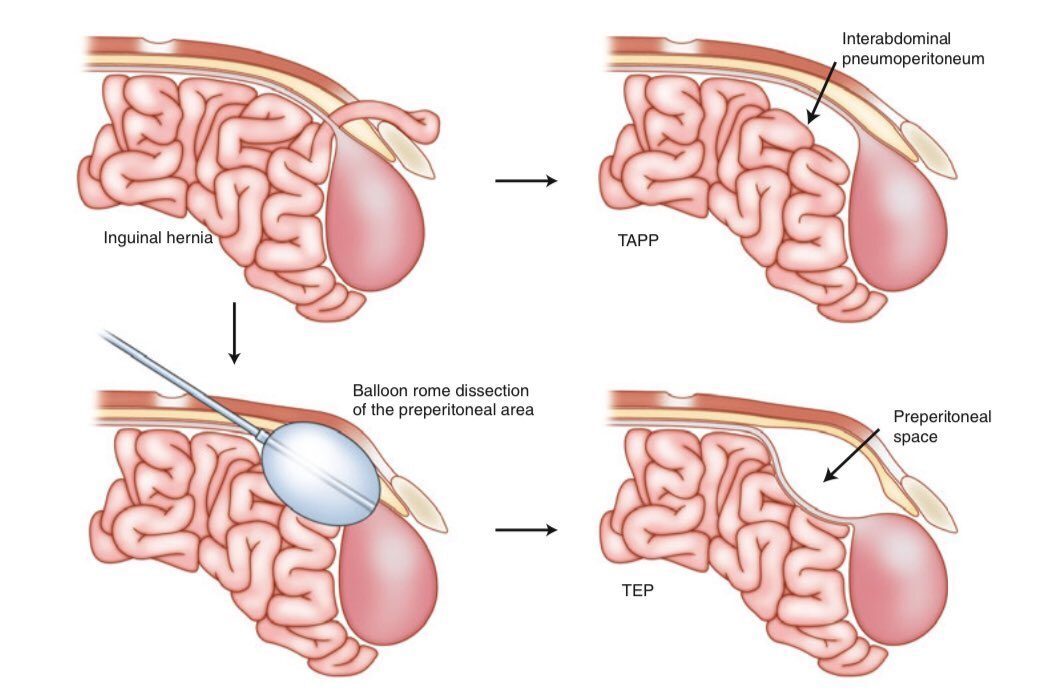 Attēls par inguinālo trūci un ķirurģiskām metodēm: TAPP, TEP, interabdominālais pneimoperitoneums, preperitoneālā