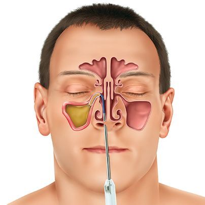Vīrieša seja ar attēlu, kas parāda deguna blakusdobumus un medicīnisku instrumentu.