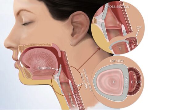 Anatomijas attēls ar rīkles un trahejas šķērsgriezumu un augšskatu, atzīmēti vārdi: Epiglottis, Traheja, CP.
