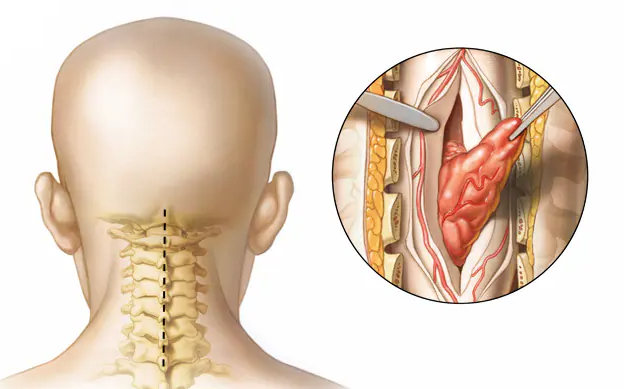 Attēls parāda cilvēka galvu no aizmugures un kakla anatomiju ar izgriezumu, kur redzams audzējs.