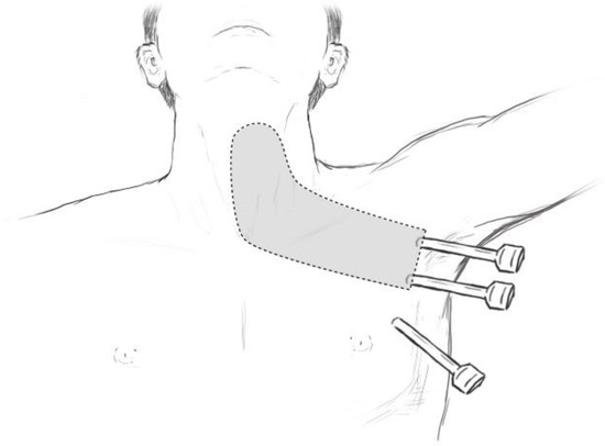 Zīmējums, kas attēlo ķirurģisku procedūru uz kakla un pleca ar instrumentiem.