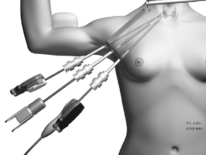 Attēls parāda cilvēka ķermeni ar medicīniskiem instrumentiem un vadiem, kas savienoti ar krūšu zonu.