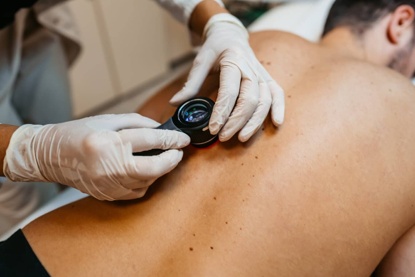 Dermatoskopija – dermatologa konsultācija ādas veidojumu un dzimumzīmju pārbaudei