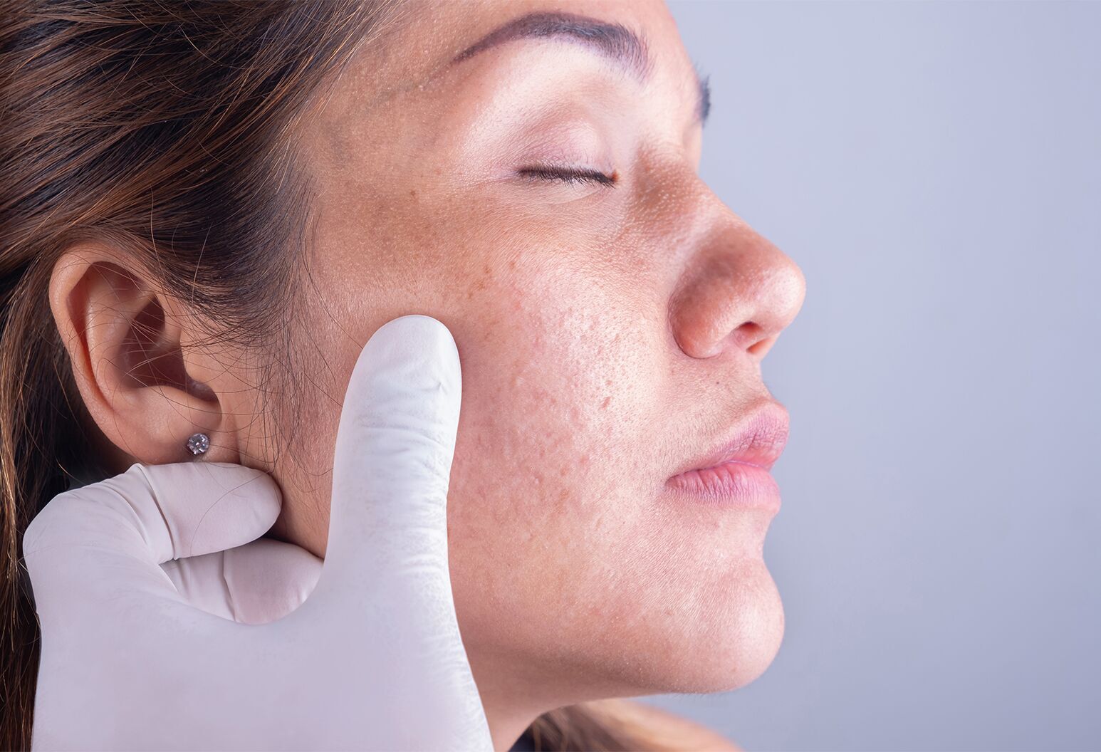 Sejas ādas izmaiņas – dermatologa konsultācija aknes un ādas problēmu diagnostikai