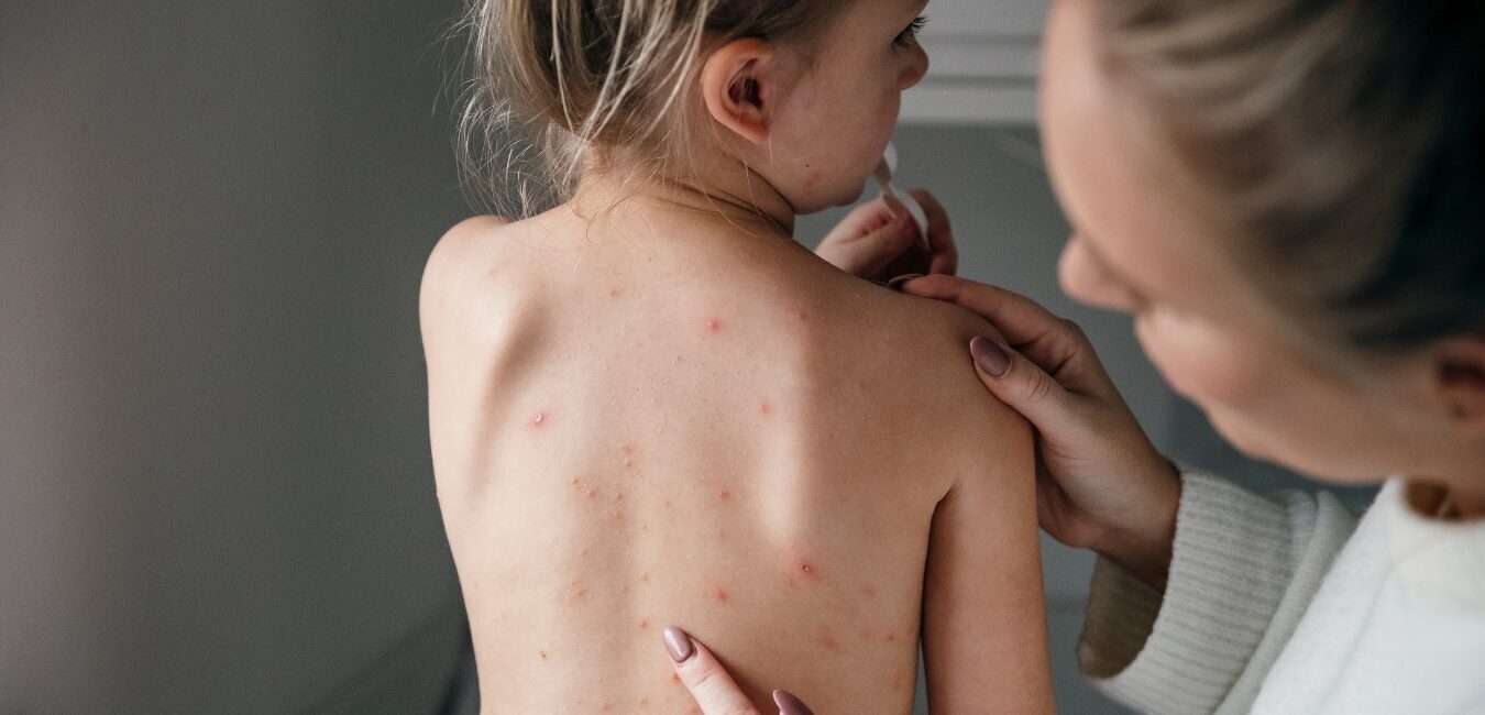 izsitumi bērnam uz muguras ādas slimību simptomi nepieciešama dermatologa konsultācija