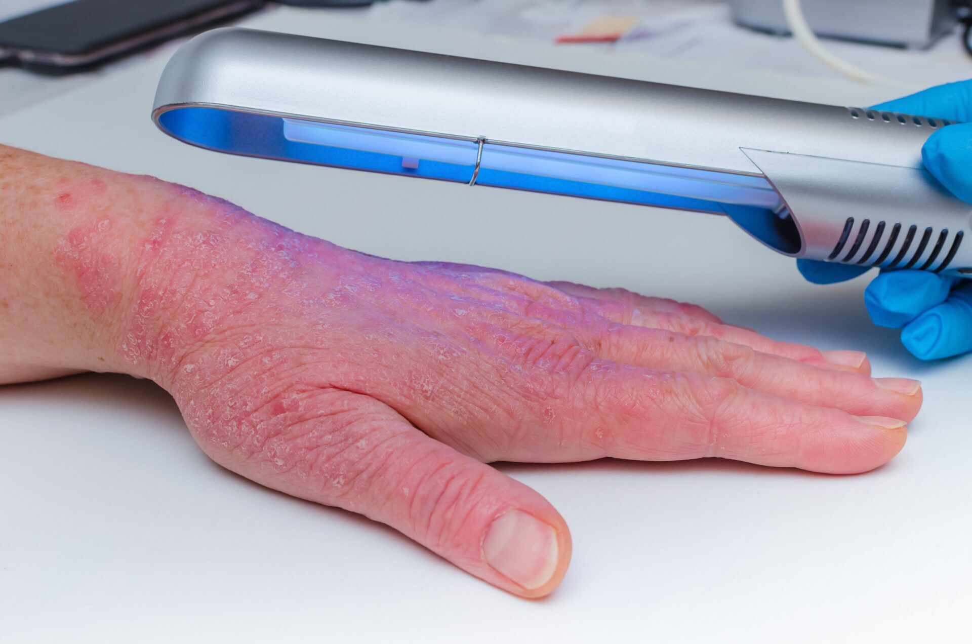 Psoriāzes ārstēšana ar fototerapiju – UVB lampa uz rokas ādas bojājumiem