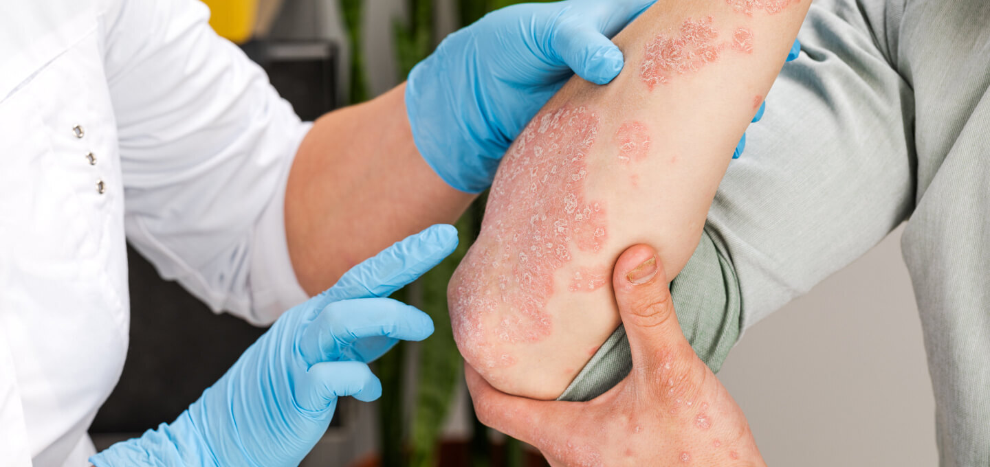 Psoriāze uz elkoņa – dermatologa konsultācija un ādas bojājumu izvērtēšana