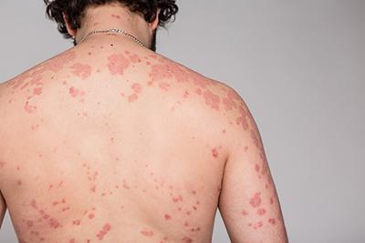 Psoriāzes izsitumi uz muguras – hroniskas ādas slimības simptomi