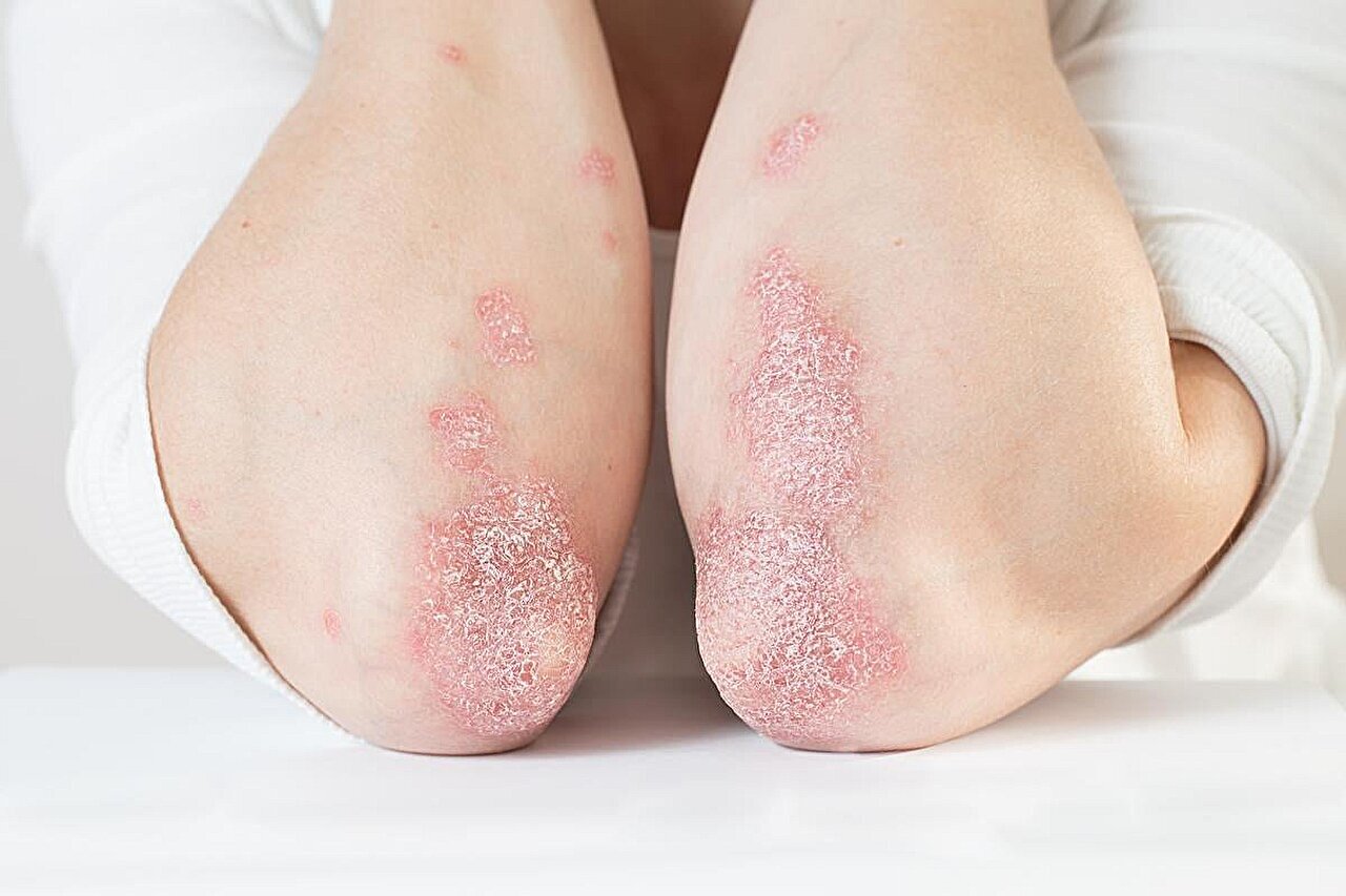 Psoriāze uz ceļgaliem – zvīņaini ādas bojājumi un iekaisums