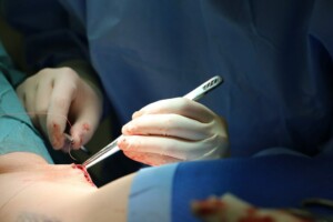 Ķirurgs veic operāciju, izmantojot instrumentus un šuvējs, redzams asins un audu fragments.